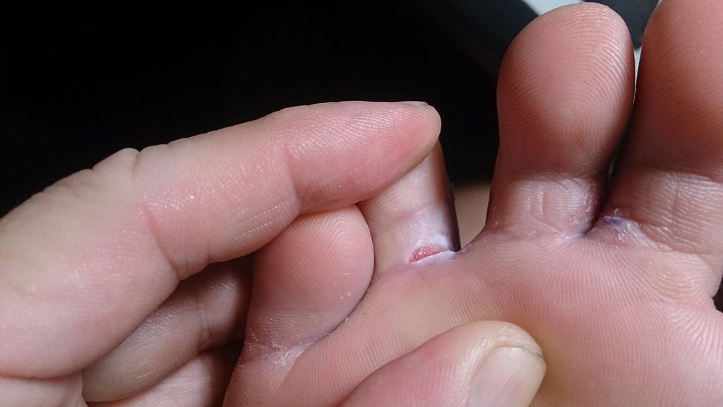 ”Athlete%27s_foot” by ProjectManhattan is licensed under CC BY-SA 3.0 Image showing a closeup of a foot with tinea pedis