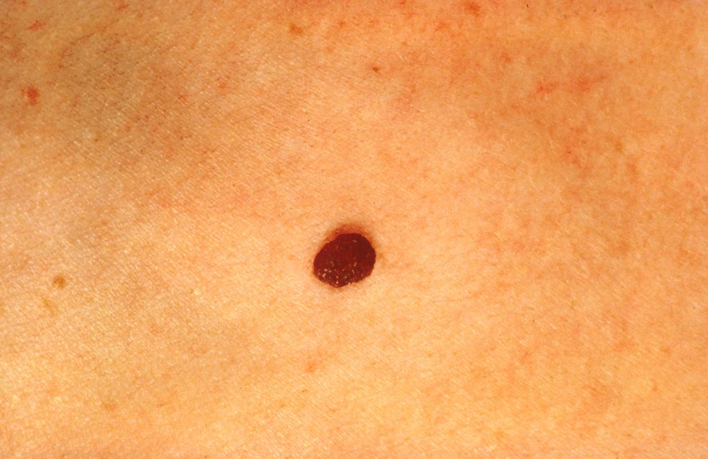 "Normal Mole with No Color Differences” by Unknown Photographer, Skin Cancer Foundation is in the Public Domain Image showing a closeup of a mole