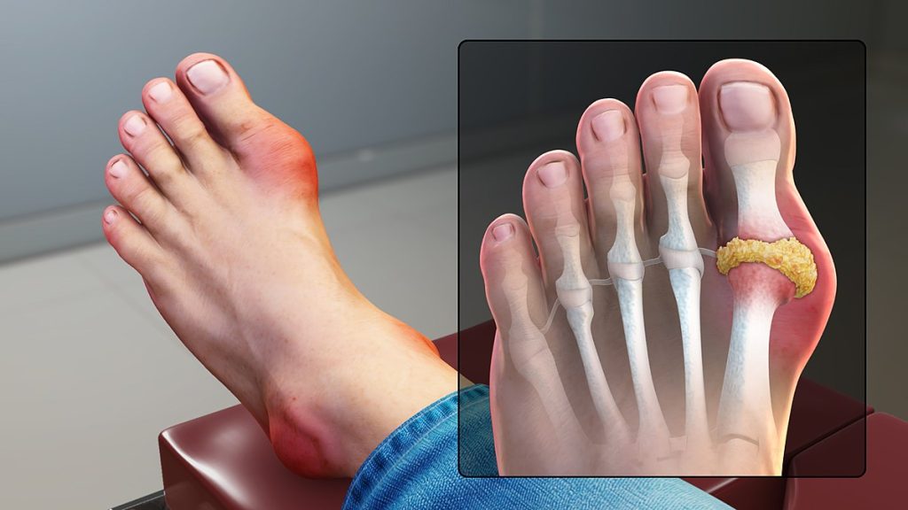 "Gout_Signs_and_Symptoms" by www.scientificanimations.com is licensed under CC BY-SA 4.0 Illustration showing the internal appearance and internal composition of gout