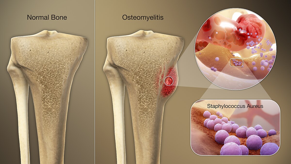 "3D_Medical_Animation_Staphylococcus_Aureus" by https://www.scientificanimations.com is licensed under CC BY-SA 4.0 Simulated comparison between a normal bone and one with osteomyelitis, with a call out showing internal composition of the affected areas