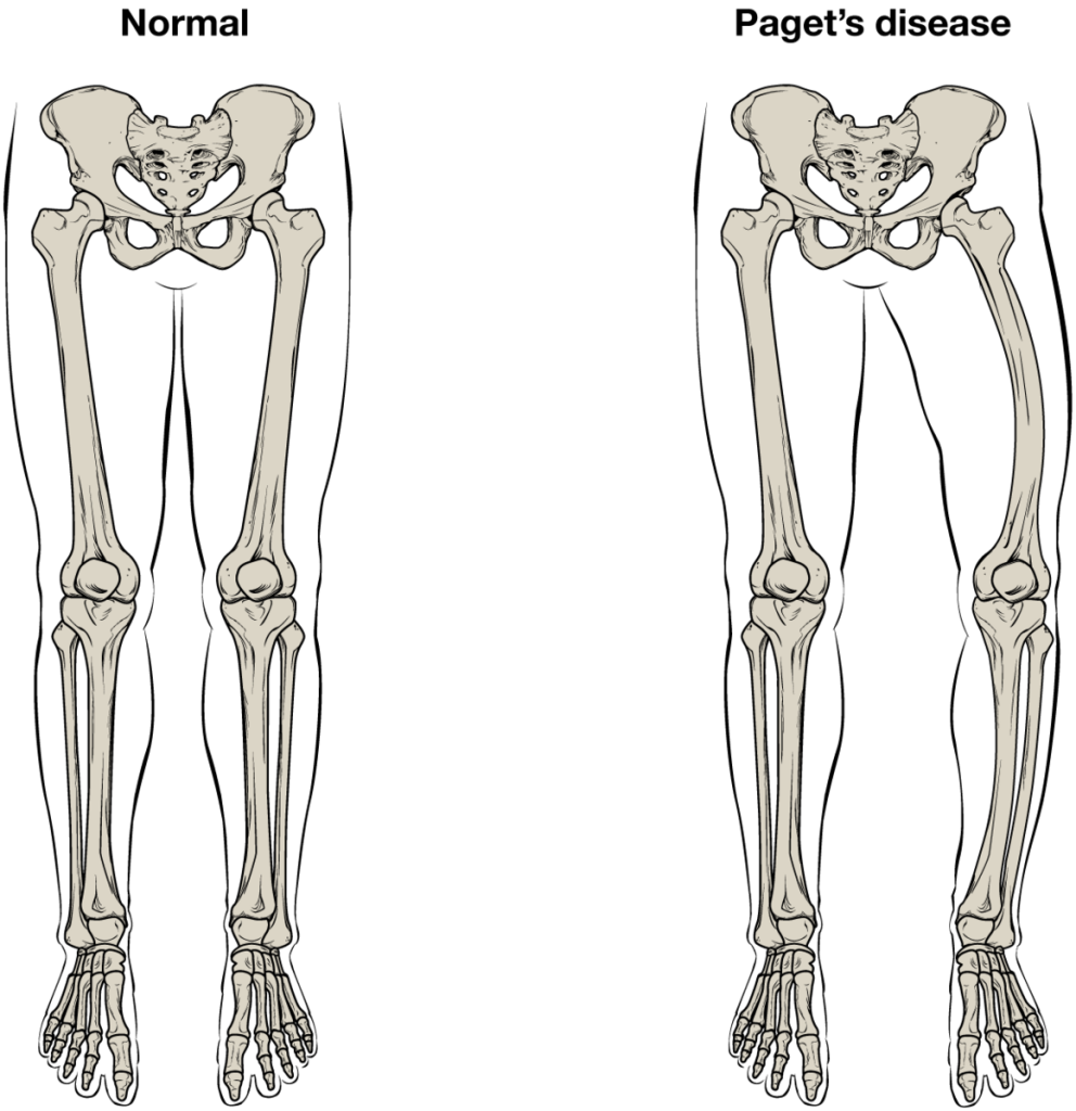 "610_Feature_Pagets_Disease" by OpenStax College is licensed under CC BY 3.0 Illustration showing a comparison between normal legs and those exhibiting the signs of Paget's disease
