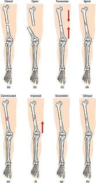 ”612_Types_of_Fractures” by OpenStax College is licensed under CC BY 3.0 Illustration showing eight different types of fractures