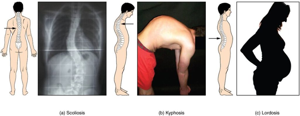 "717_Abnormal_Curves_of_Vertebral_Column" by OpenStax College is licensed under CC BY 3.0 Illustrations and patient examples of scoliosis, kyphosis, and lordosis