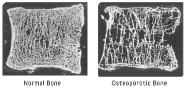"Bone_Comparison_of_Healthy_and_Osteoporotic_Vertibrae" by Turner Biomechanics Laboratory is licensed under CC0, Public Domain. A comparison of normal bone and that is osteoporotic