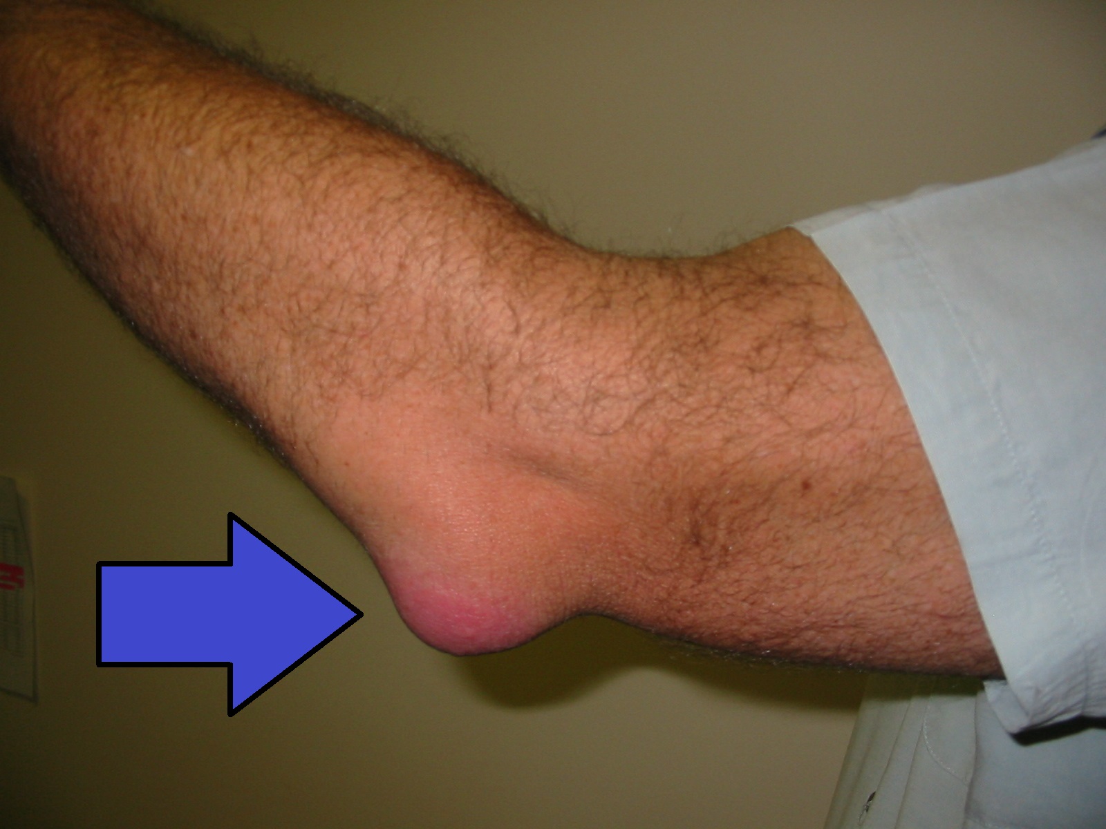 "Bursitis_Elbow_WCArrow" by en:User:NJC123 is licensed under CC0, Public Domain An arrow pointing at an elbow with bursitis