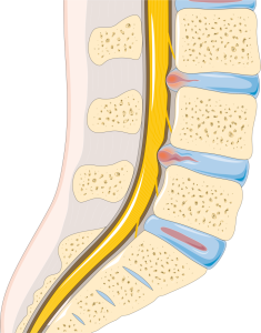 "Disc_herniation_--_Smart-Servier" by Smart Servier is licensed under CC BY-SA 3.0 Illustration showing location and example of a herniated disc