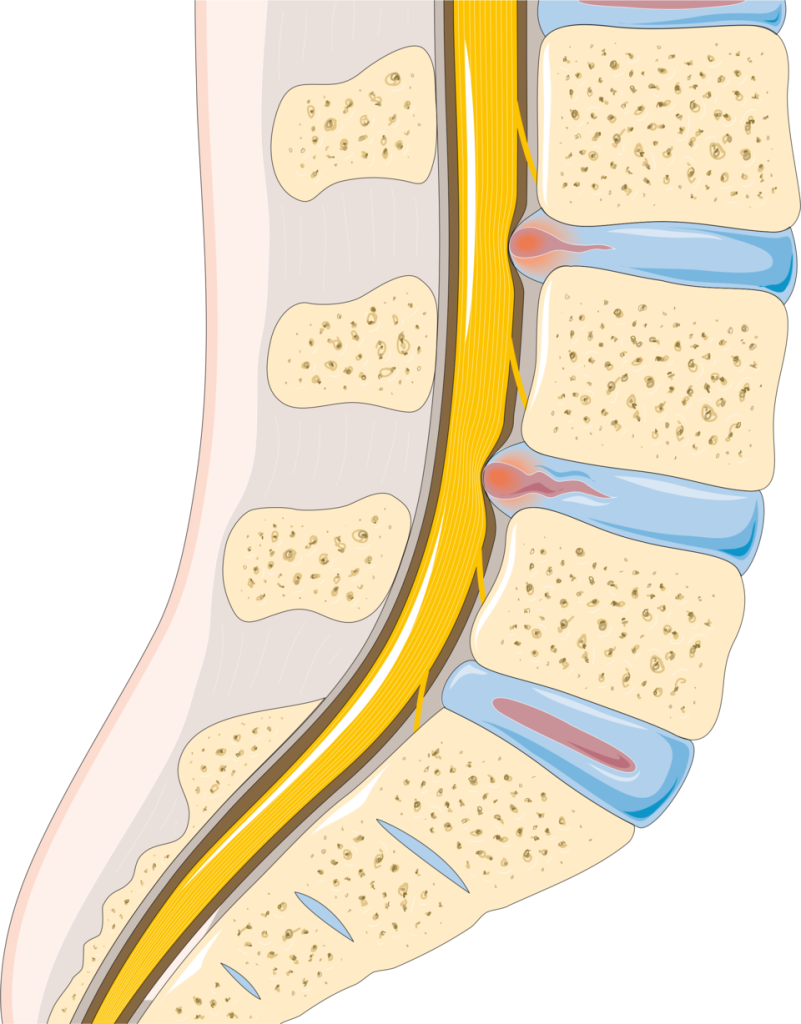 "Disc_herniation_--_Smart-Servier" by Smart Servier is licensed under CC BY-SA 3.0 Illustration showing location and example of a herniated disc