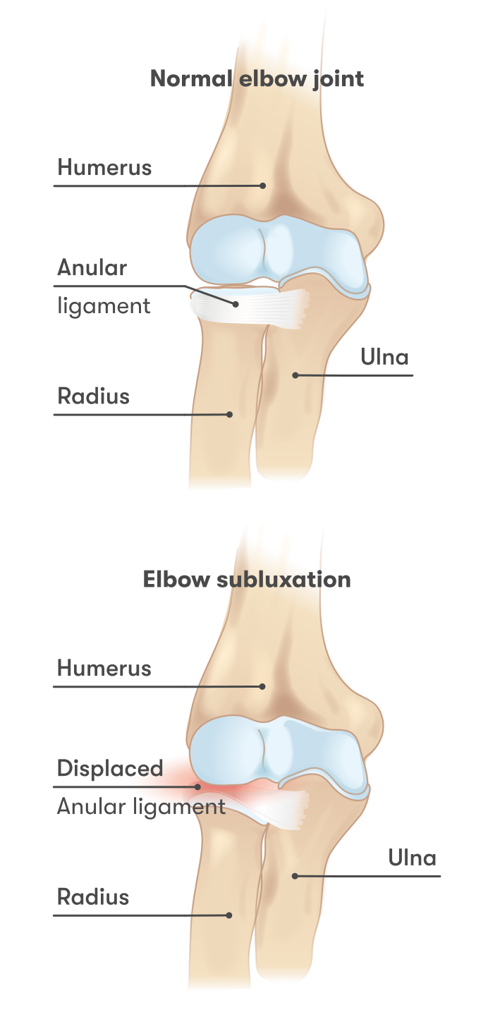 "Elbow_subluxation_2" by InjuryMap is licensed under CC BY-SA 4.0 Illustration showing a comparison between a normal elbow joint an done with subluxation