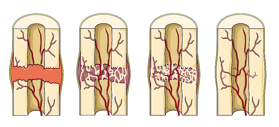 "Fracture_repair_--_Smart-Servier_(cropped)" by Laboratoires Servier is licensed under CC BY-SA 3.0 Illustration showing the process of fracture repair