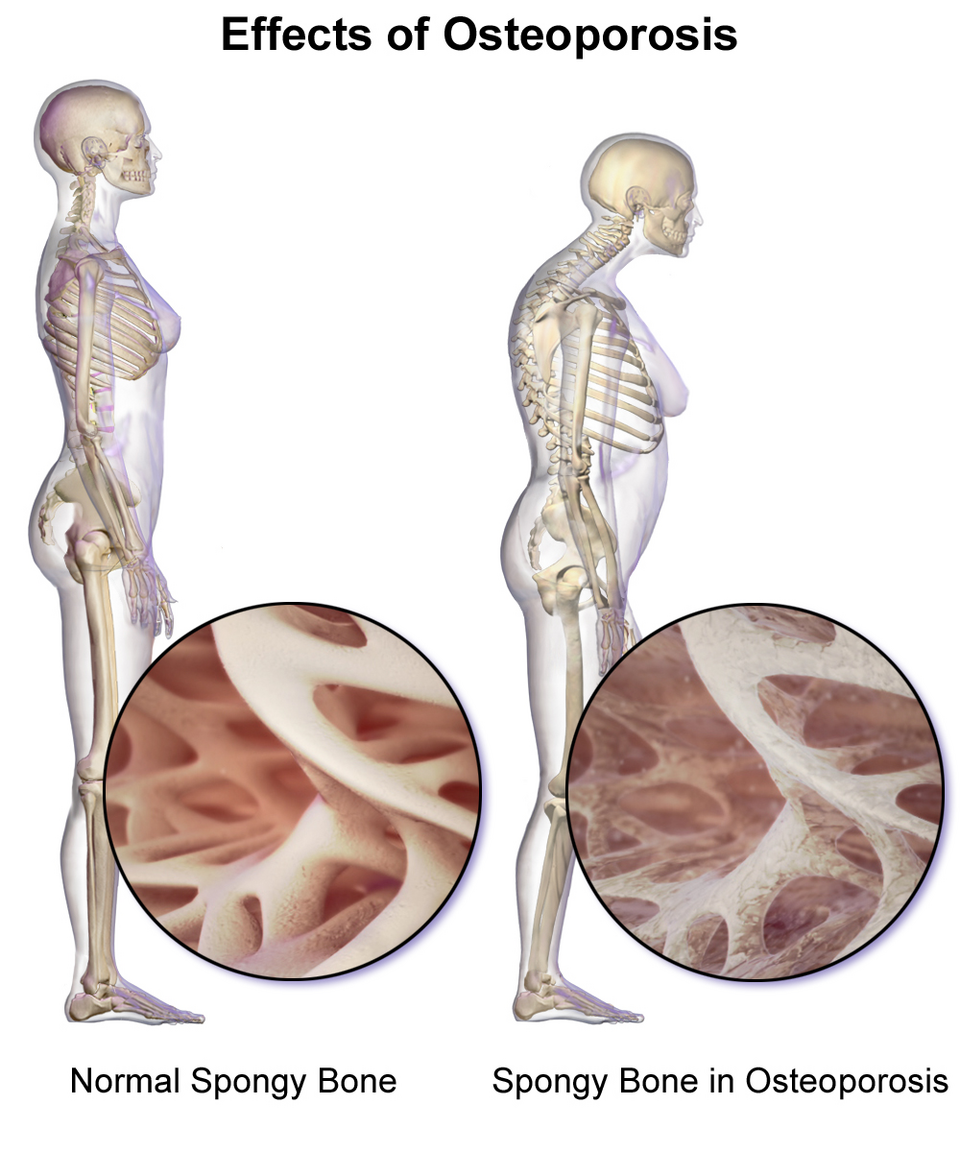"Osteoporosis_02" by BruceBlaus is licensed under CC BY-SA 4.0 Illustration showing the effects of osteoporosis on spongy bone