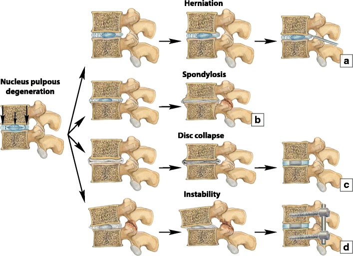 "Surgical_treatment_options_for_degenerative_changes" by Irina Nefedova is licensed under CC BY 4.0 Illustration showing examples of herniation, spondylosis, disc collapse, and instability
