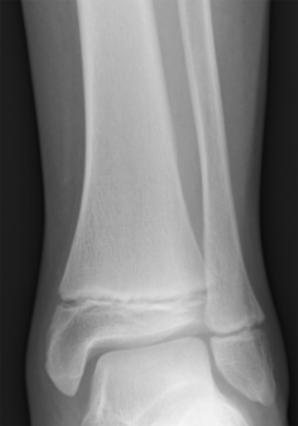 "Tib_fib_growth_plates" by Gilo1969 is licensed under CC BY 3.0 Xray showing a close up of bone plates