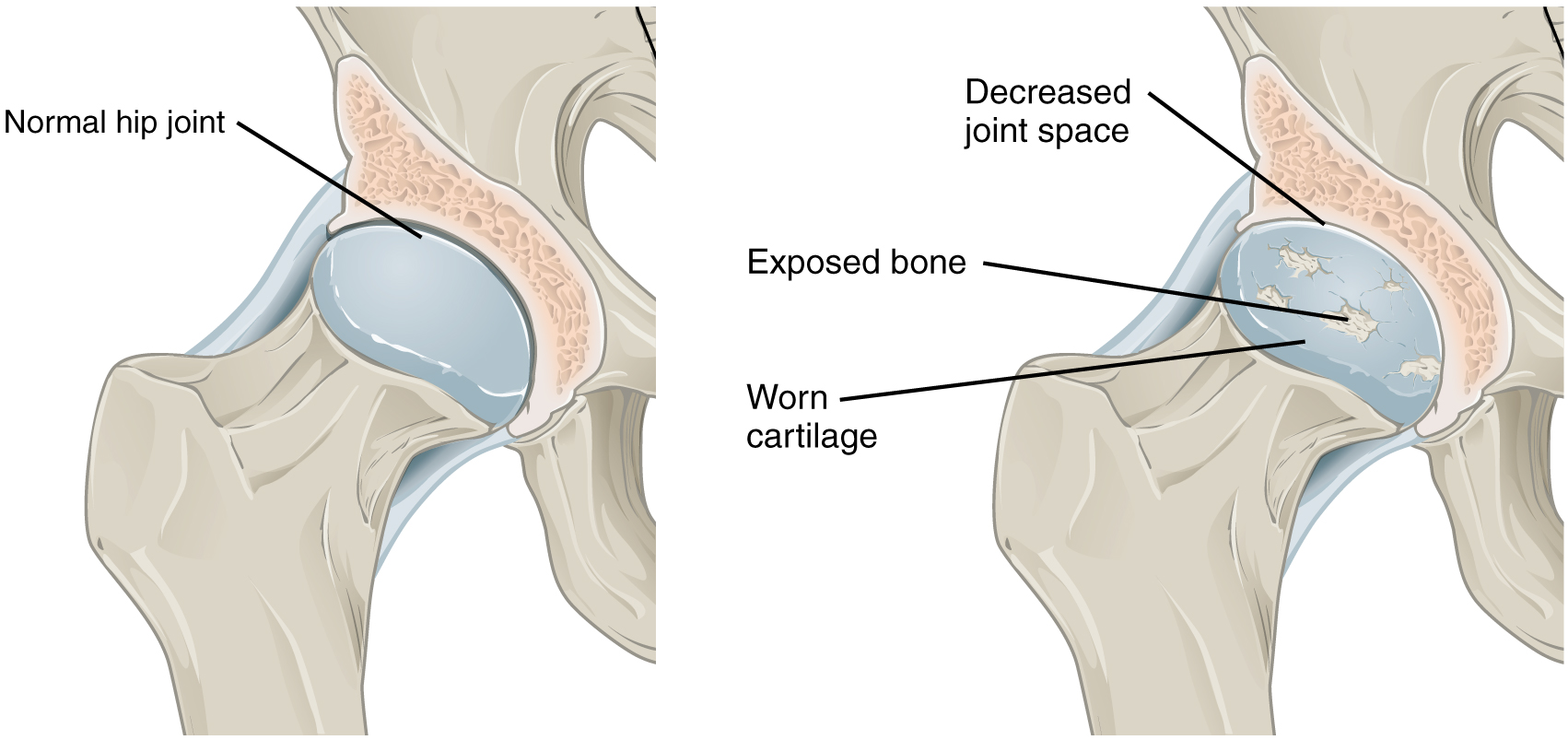 ”e805ac89b71c1ed264f89d79472b1ed9d7d0834e” by OpenStax College is licensed under CC BY 4.0. Access for free at https://openstax.org/books/anatomy-and-physiology-2e/pages/9-4-synovial-joints#fig-ch09_04_04 Illustration showing a comparison between a normal hip join and one with signs of osteoarthritis