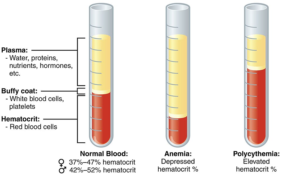 “1901_Composition_of_Blood” by OpenStax College is licensed under CC BY 3.0 Illustration showing the composition of blood in three vials with text labels for normal blood, anemia, and polycythemia