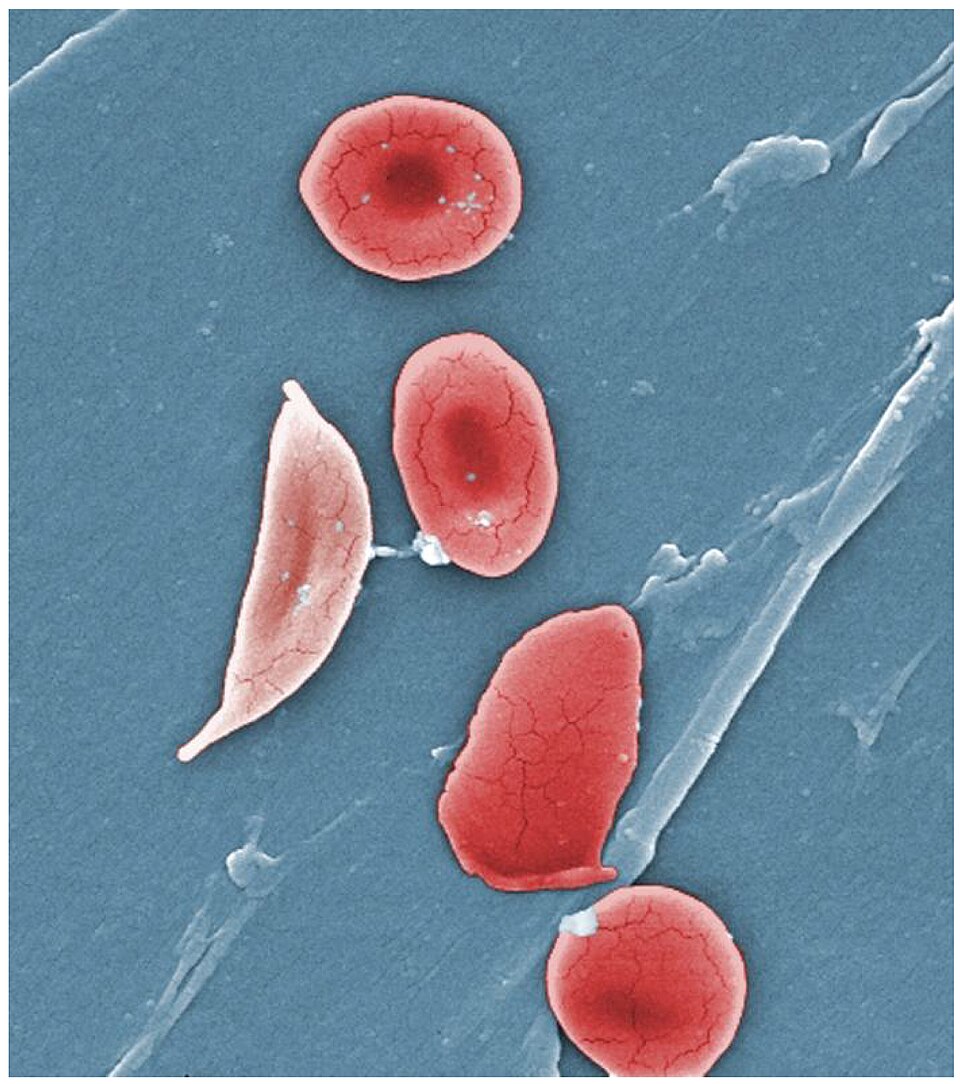 Micrograph showing sickled erythrocytes