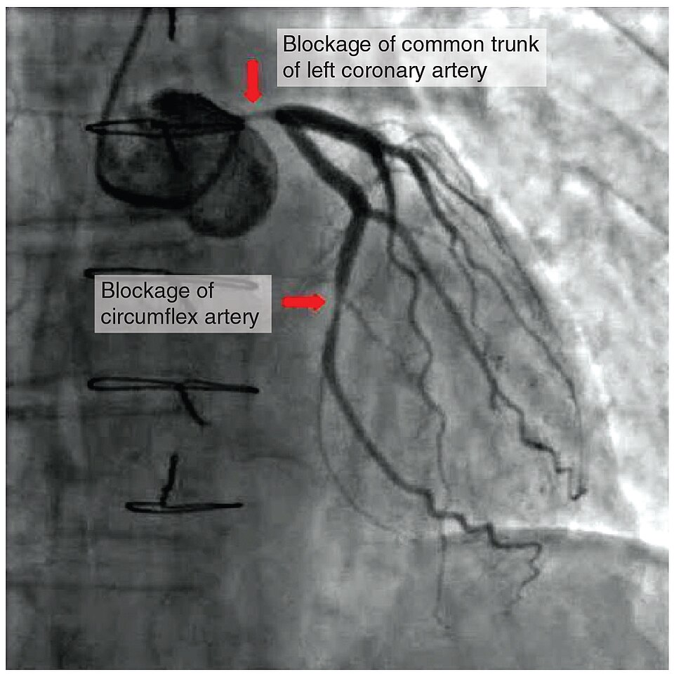 “2016_Occluded_Coronary_Arteries” by OpenStax College is licensed under CC BY 3.0 An Xray showing blockage of common trunk of left artery and circumflex artery