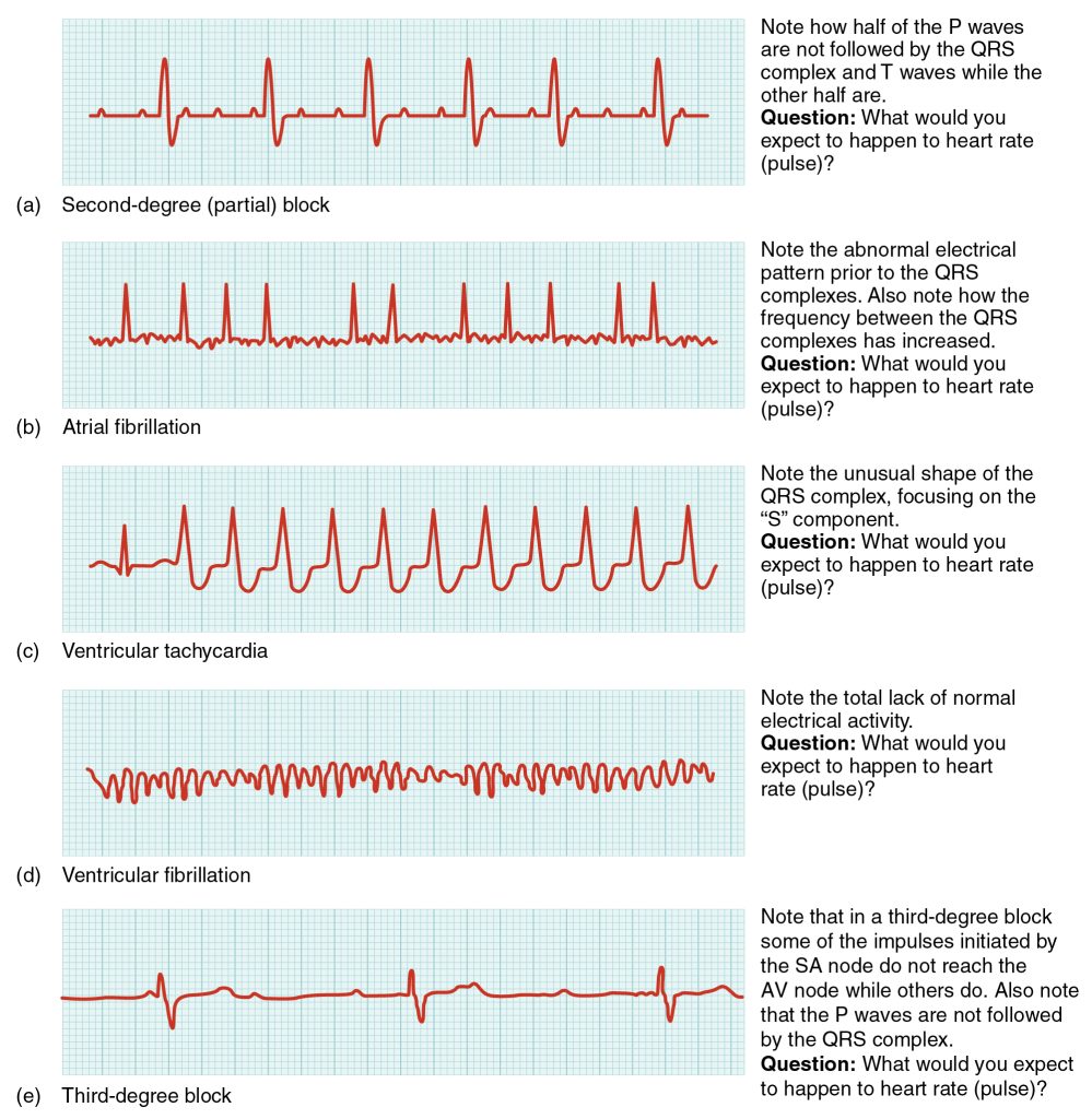 "2024_Cardiac_Arrhythmias" by OpenStax College is licensed under CC By 3.0 ECG tracings showing cardiac arrhythmias