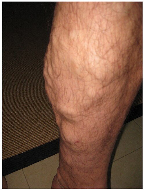 “2107_Varicose_Vein” by OpenStax College is licensed under CC BY 3.0 Closeup of varicose veins in a patient's lower leg