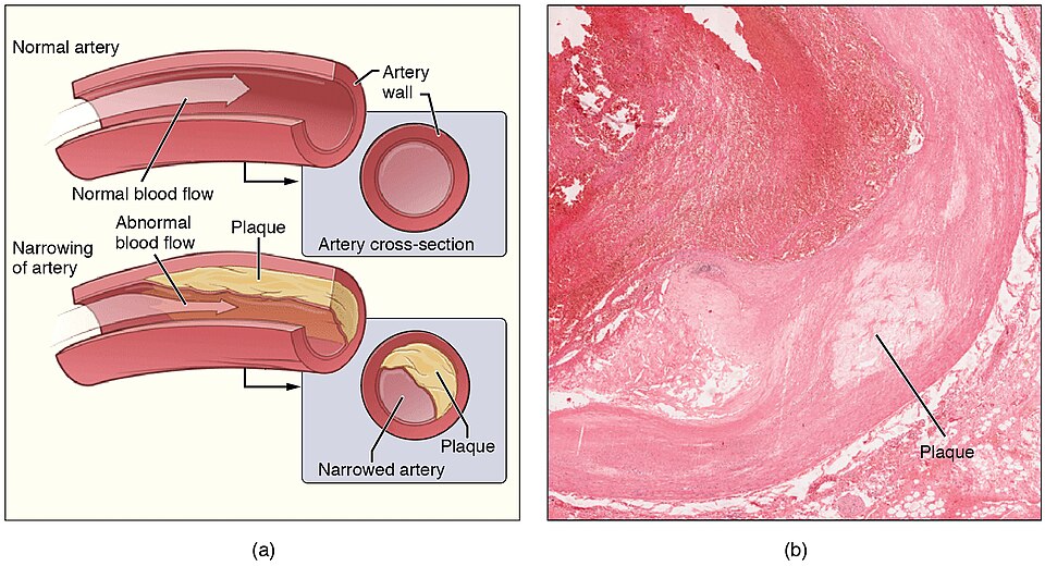 ”2113ab_Atherosclerosis.” by OpenStax College is licensed under CC BY 3.0 Illustration and micrograph showing atherosclerosis