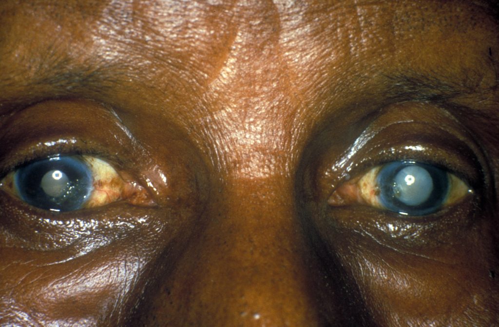 Person with cloudy lens due to bilateral cataracts