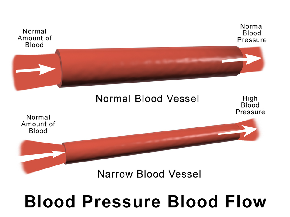 "Blausen_0092_BloodPressureFlow" by Blausen.com staff (2014). "Medical gallery of Blausen Medical 2014 is licensed under CC BY 3.0 Illustration showing blood pressure flow in both a normal and narrow blood vessel