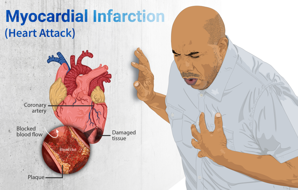 “Depiction_of_a_person_suffering_from_a_heart_attack_(Myocardial_Infarction).png” by https://www.myupchar.com/en is licensed under CC BY-SA 4.0 Infographic depicting a simulated patient experiencing a heart attack with illustration and micrograph showing blocked flow in the coronary artery