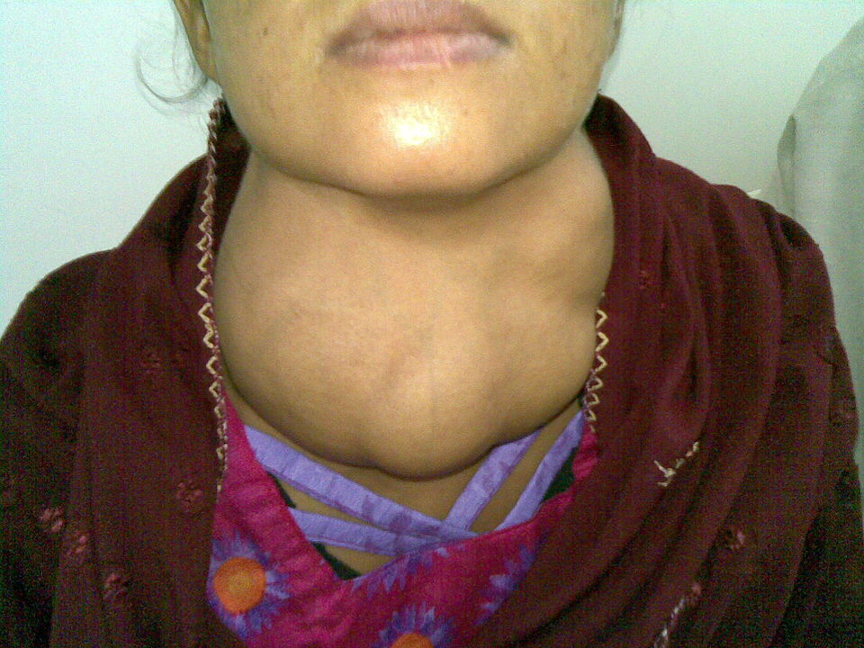 “Goitre” by Almazi is in the Public Domain A large goiter on a person's lower neck