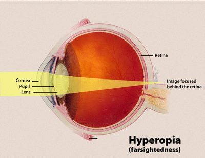 Illustration showing process of hyperopia in the eye