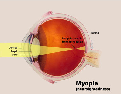 Illustration showing process of myopia in eye