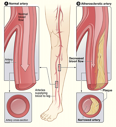“Peripheral_Arterial_Disease.gif” by National Heart Lung and Blood Institute is in the Public Domain Illustration comparing a normal leg artery with an antherosclerotic artery
