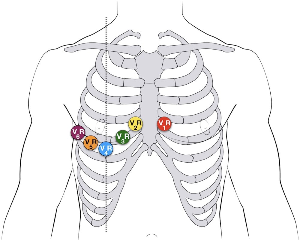 https://litfl.com/ecg-lead-positioning/ Illustration showing ecg placement