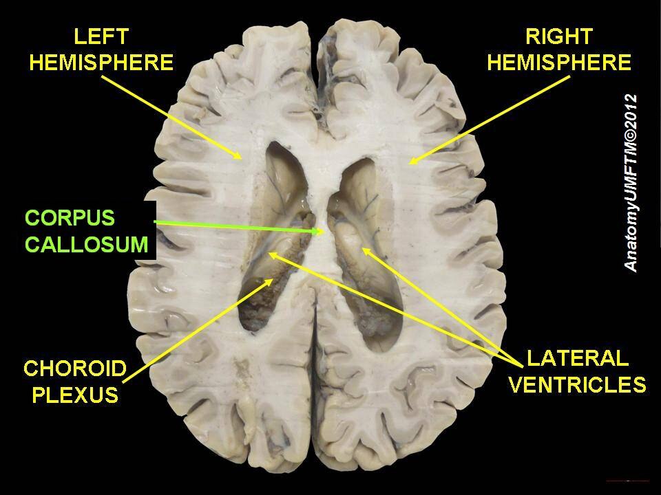 Anatomical dissection showing major structures of brain and location of corpus callosum
