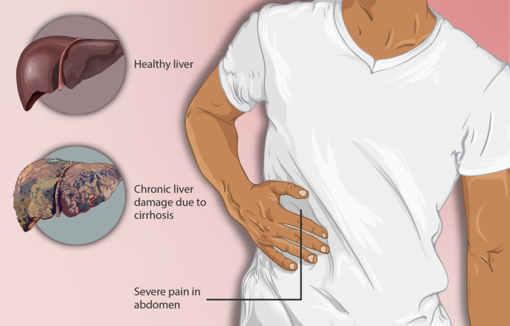 "Depiction_of_a_Cirrhosis_patient” by https://www.myupchar.com/en is licensed under CC BY 4.0 Illustration comparing a healthy liver to one with chronic liver damage, along with a depiction of a cirrhosis patient with pain