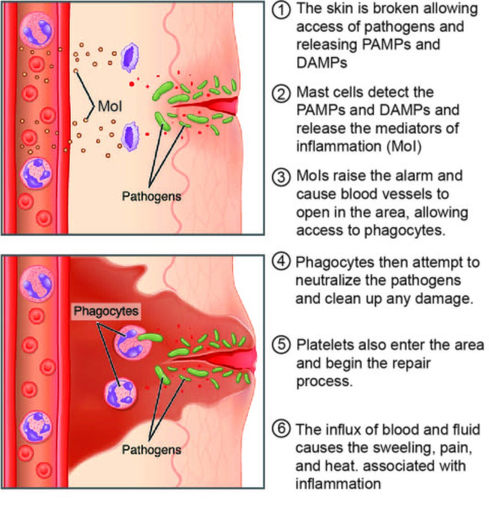 ”2213_Inflammatory_Process” by OpenStax College is licensed under CC BY 3.0 Illustration showing inflammatory process