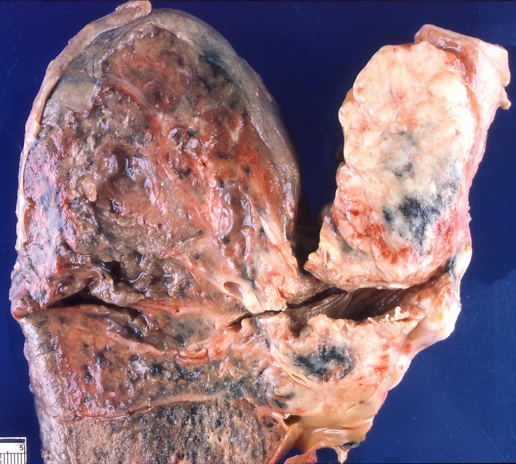 A lung impacted by small cell carcinoma
