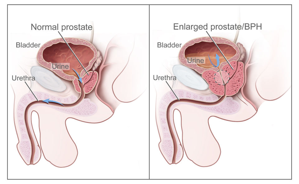 Illustration showing a comparison between a normal and enlarged prostate