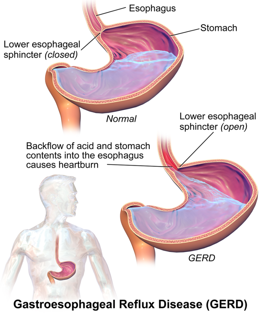 "GERD” by BruceBlaus is licensed under CC BY 4.0 Illustration comparing a normal stomach with one impacted by GERD