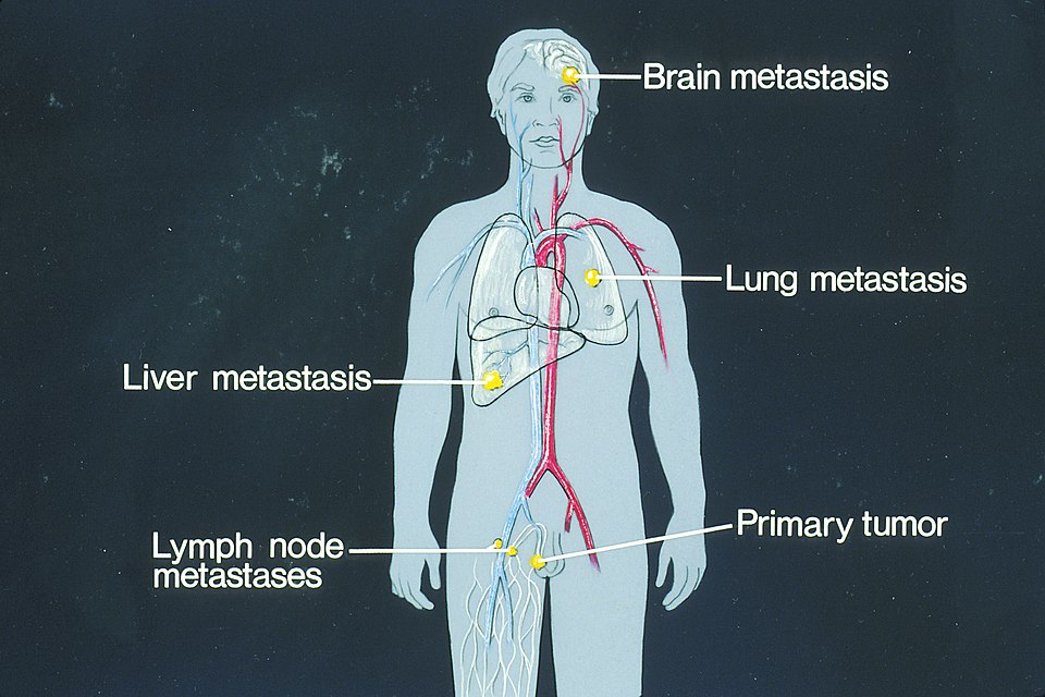 “Sites_of_potential_metastases_illustration.jpg” by unknown author, via National Cancer Institute is licensed in the Public Domain Illustration showing potential metastases locations on a human form