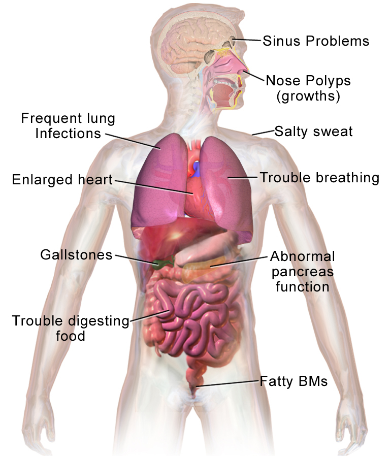Illustration showing impact of cystic fibrosis on body systems