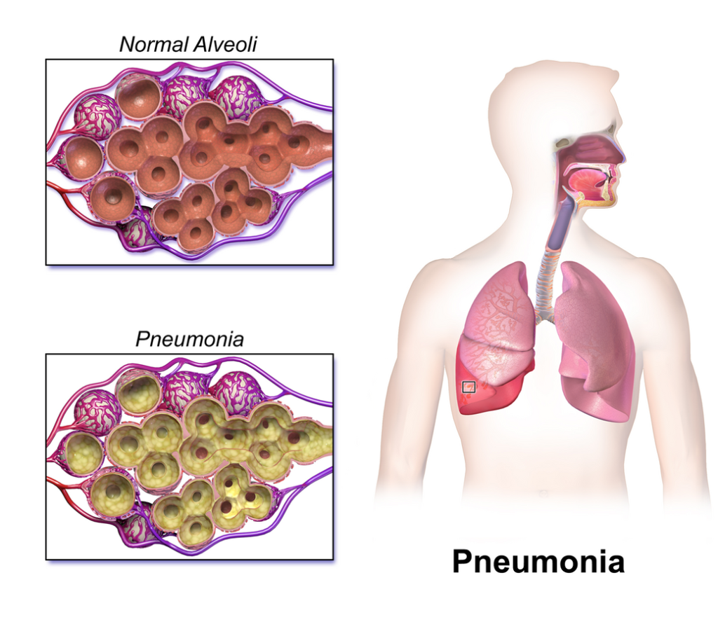 Illustration comparing normal alveoli with those impacted by pnuemonia