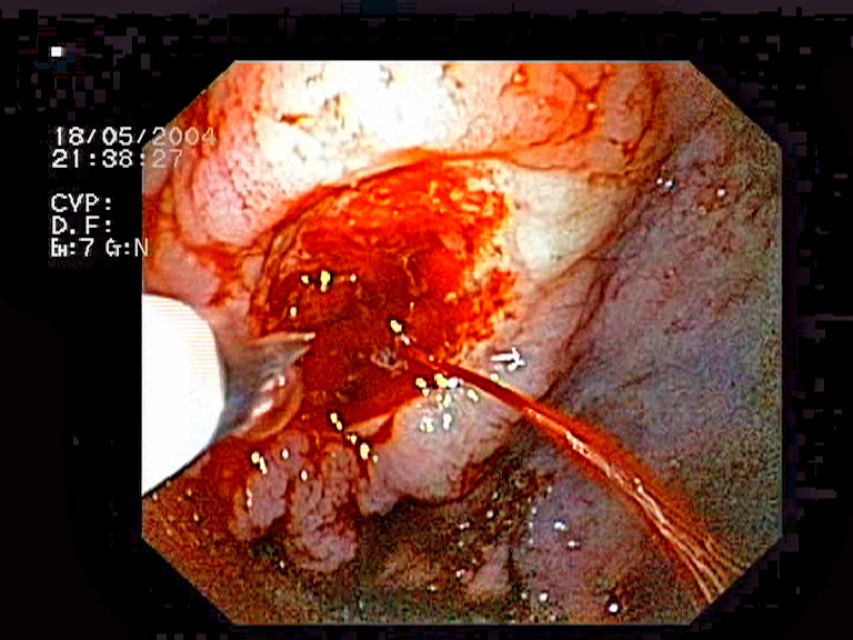 "Bleeding_gastric_ulcer” by Jeremias is licensed under CC BY 3.0 Endoscopic view of a bleeding gastric ulcer