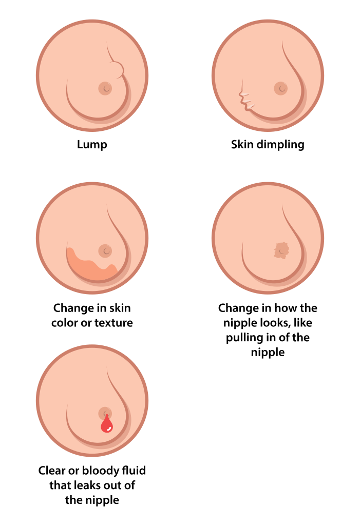Illustration showing breast cancer symptoms on a five breasts