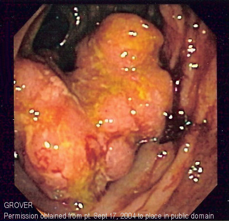 ”Colorectal_cancer_endo_2” by unknown author is licensed under CC BY 3.0 Endoscopic image showing colorectal cancer