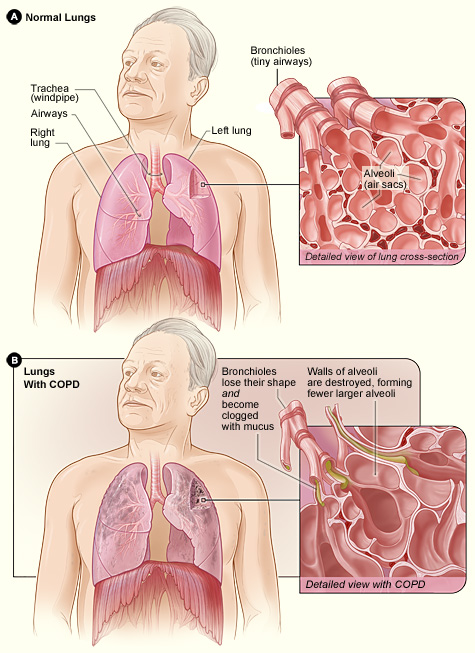 Illustration comparing normal lungs with those impacted by C O P D