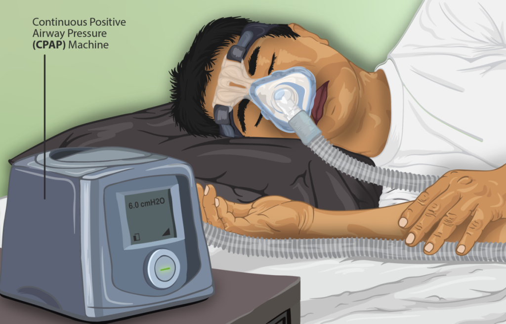 Illustration showing a person using a CPAP machine