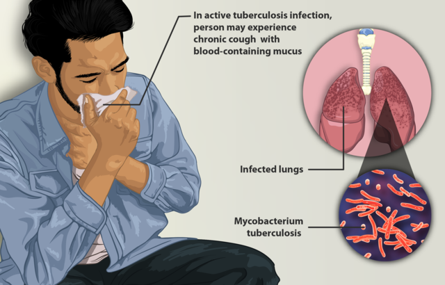 Illustration depicting a tuberculosis patient