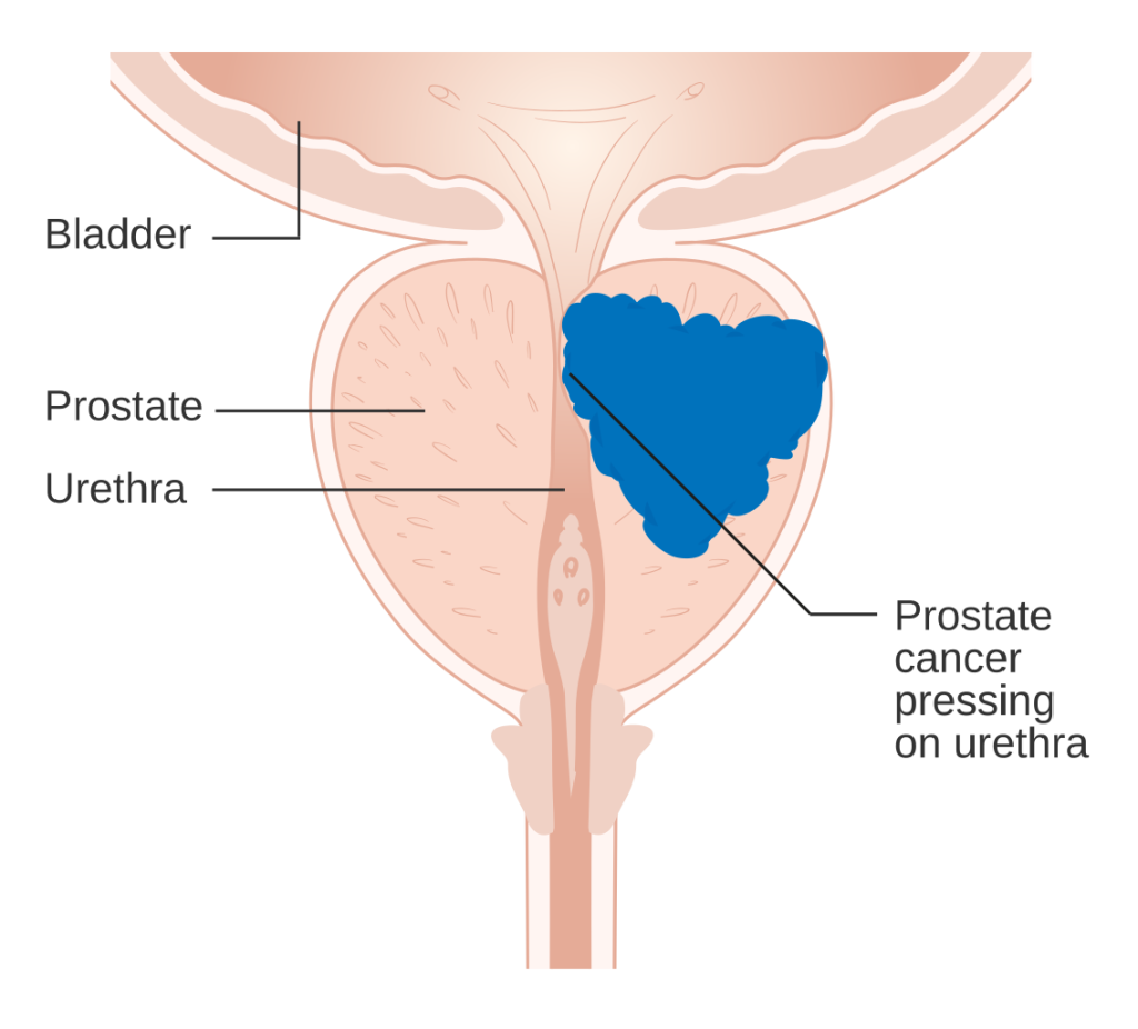 Illustration showing location and presentation of prostate cancer