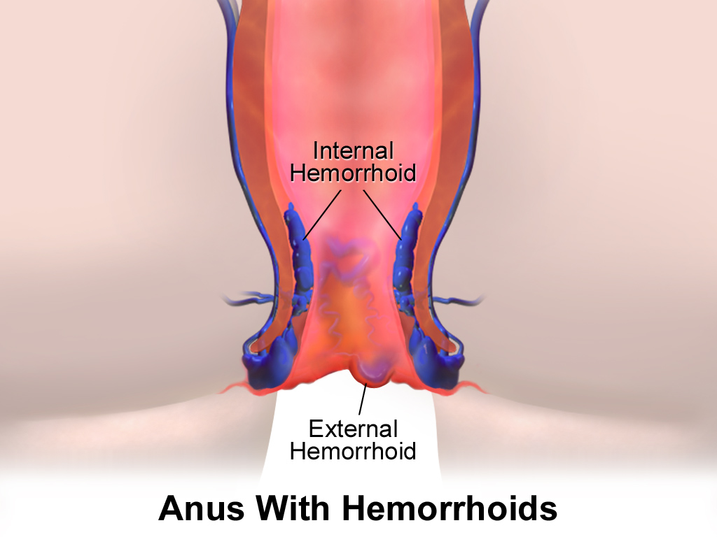 "Hemorrhoids” by BruceBlaus licensed under CC BY 4.0 Illustration showing location and structure of hemorrhoids