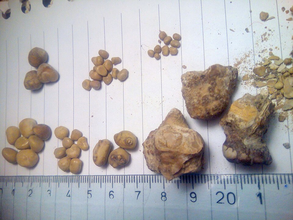 Various size kidney stones next to a ruler