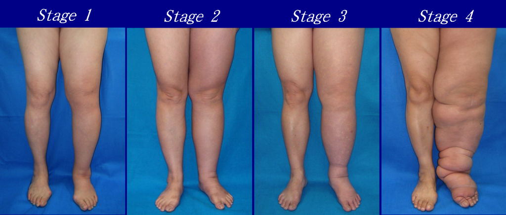 "Lower_Limb_Lymphedema" by DocHealer is licensed under CC BY-SA 4.0 Four stages of lower limb lymphedema